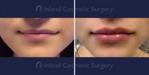 Lip Augmentation Patient