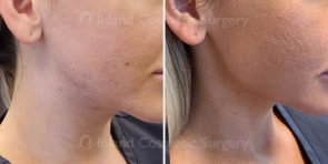 injectable-fillers-jawline-18780c-inlandcs