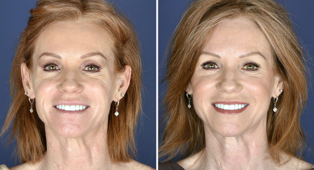 Before and after non-surgical facelift