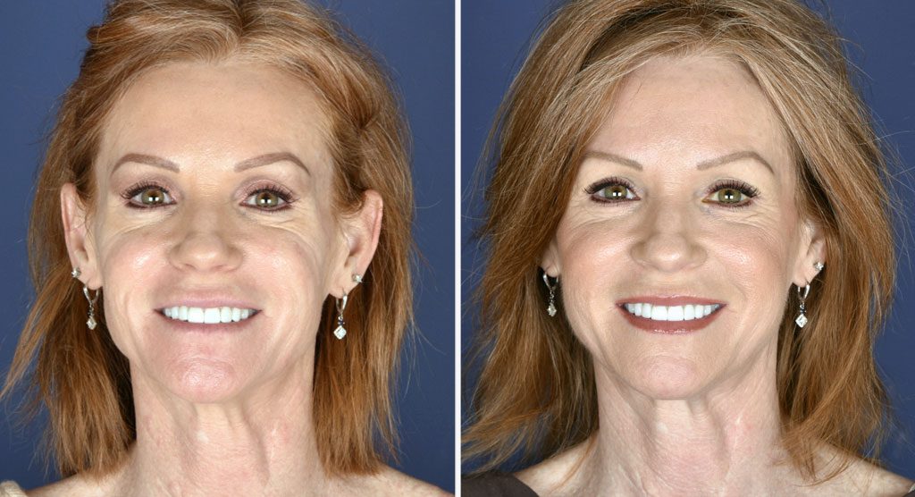 Non-Surgical Face Lift