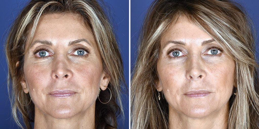 Non-Surgical Rhinoplasty Patient