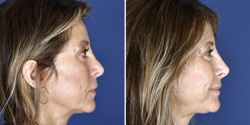 Before and after non-surgical nose job