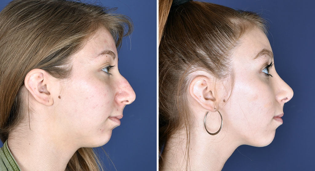 Rhinoplasty Patient Dr. Haiavy in Rancho Cucamonga