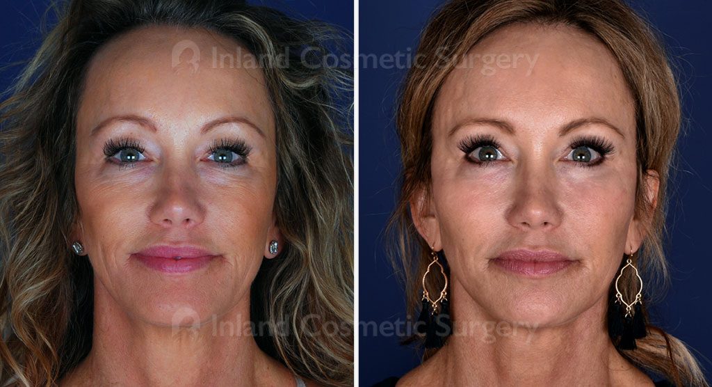 Facial Rejuvenation