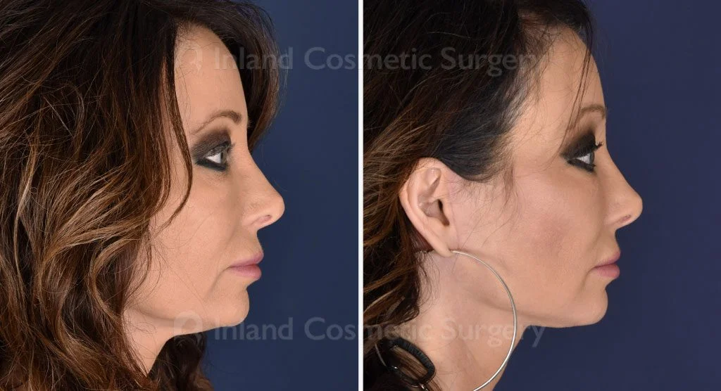 Facial Rejuvenation