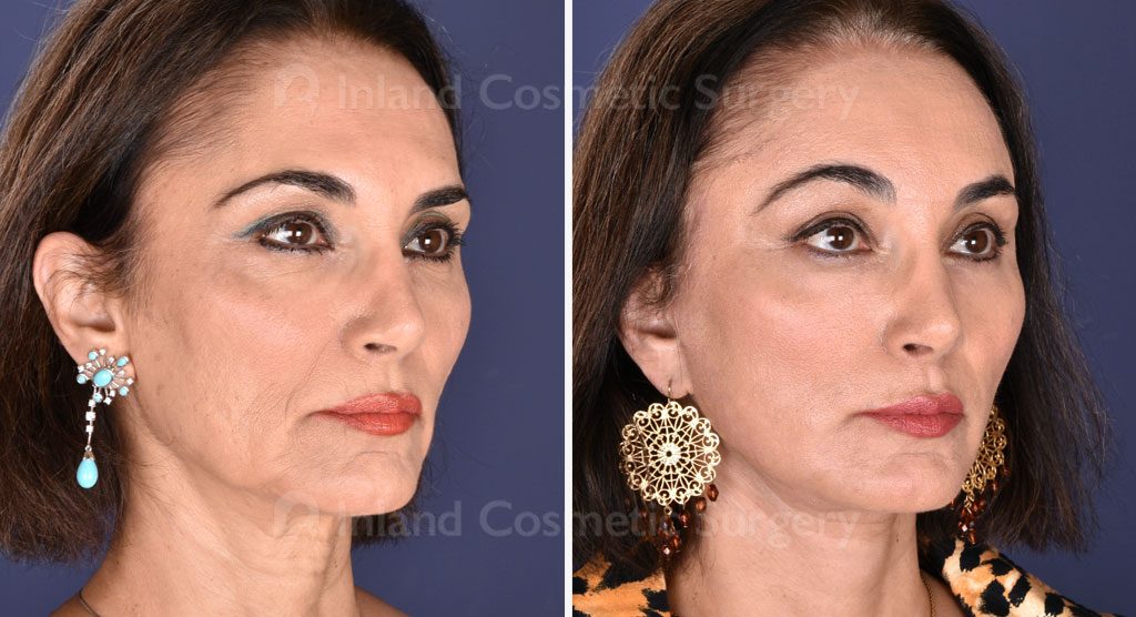 Facial Rejuvenation