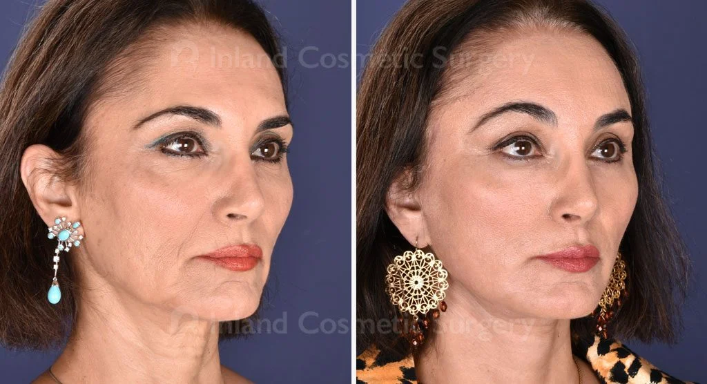 Facial Rejuvenation
