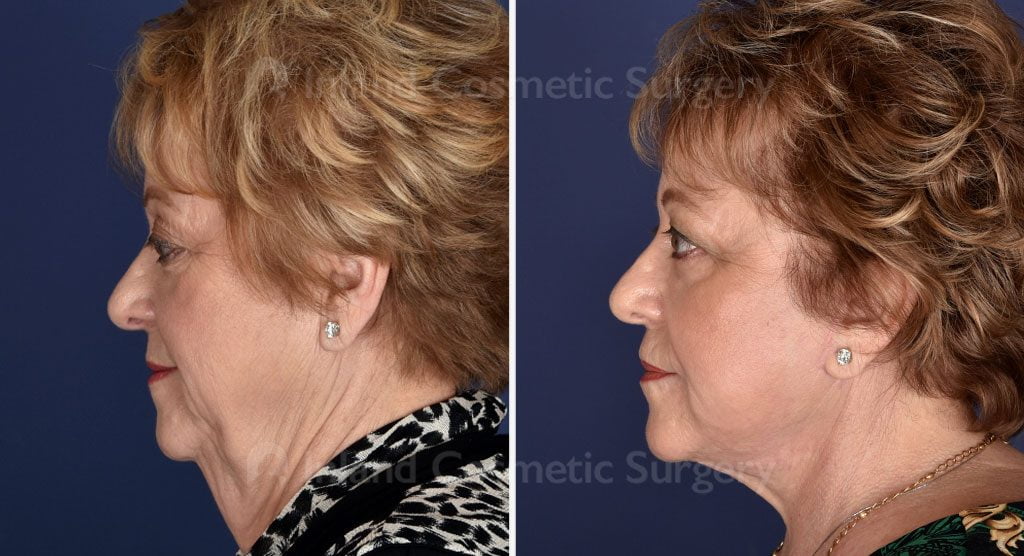 Before and after  facelift, neck lift, endoscopic brow lift, fat transfer to the face, full face TCA peel and 2cc of Juvederm injectable filler