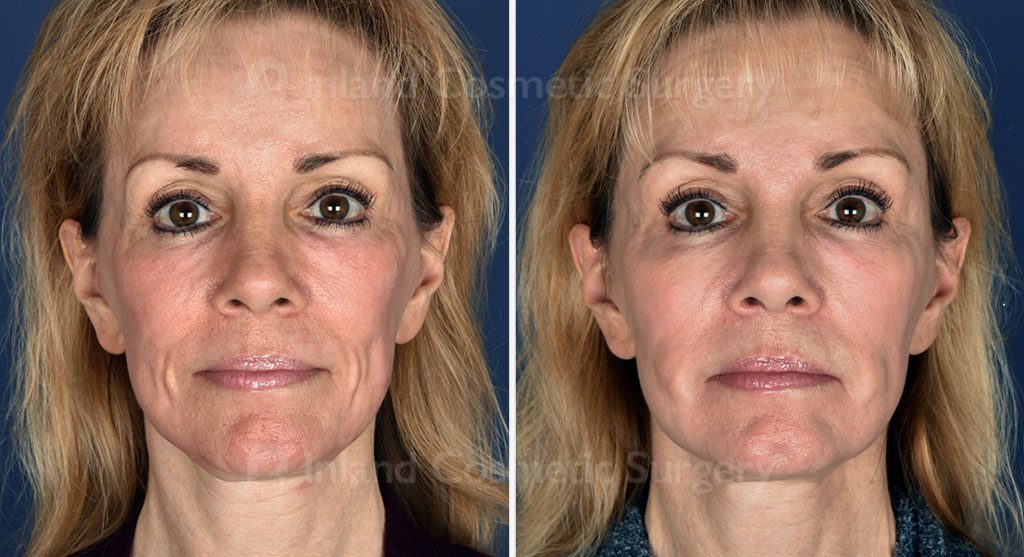 Facial Fat Transfer