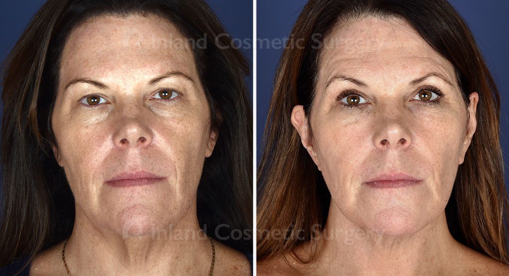 Facial Rejuvenation