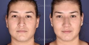 Non-Surgical Rhinoplasty Patient