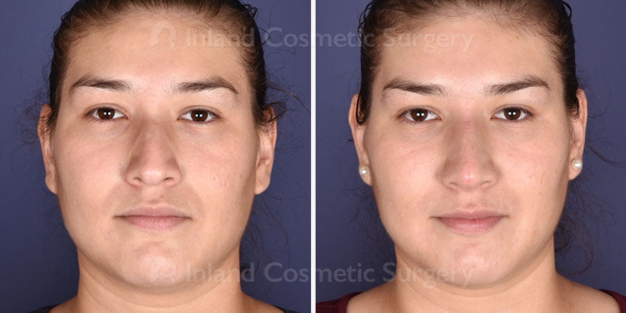 Non-Surgical Rhinoplasty