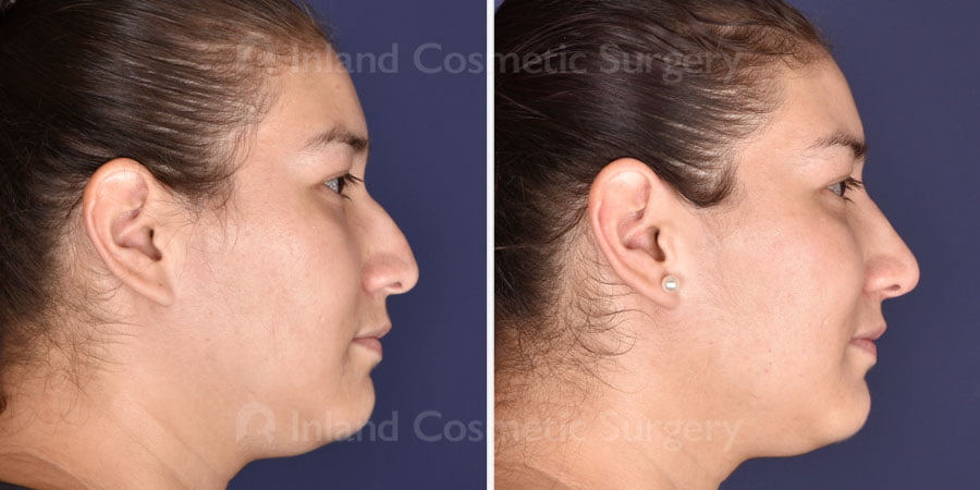 Before and after non-surgical rhinoplasty