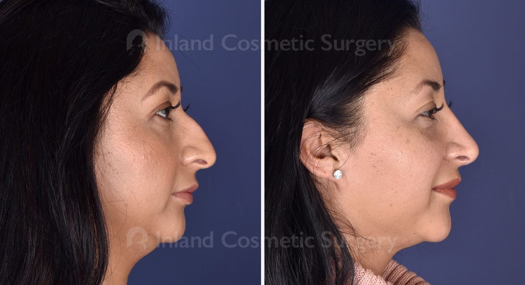 Rhinoplasty Patient