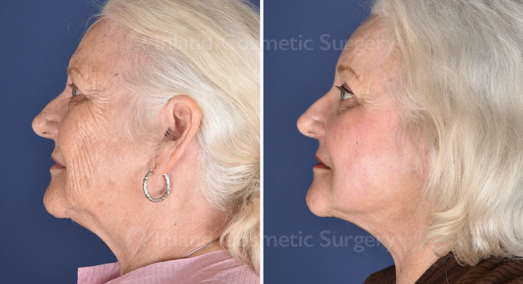 Facial Rejuvenation