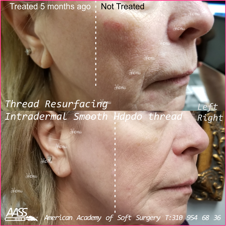 HDPDO Thread Lift Before and After