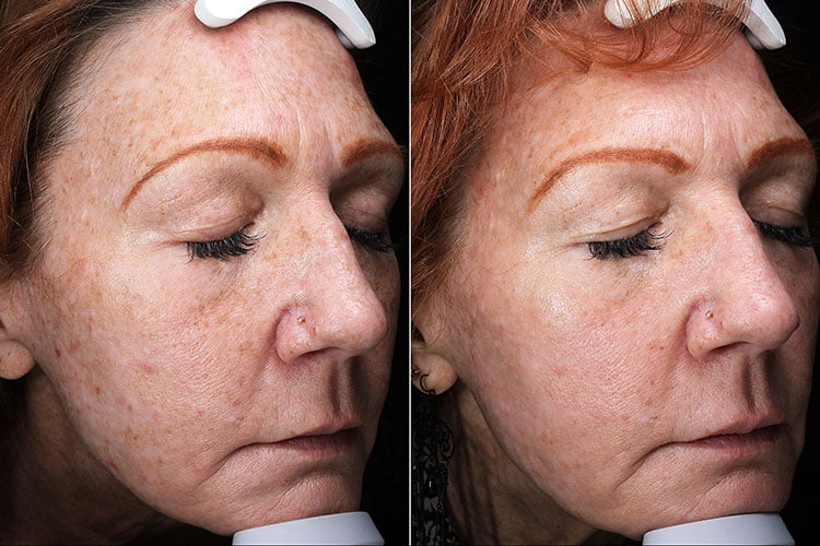 Before and after MixTo laser skin resurfacing treatments