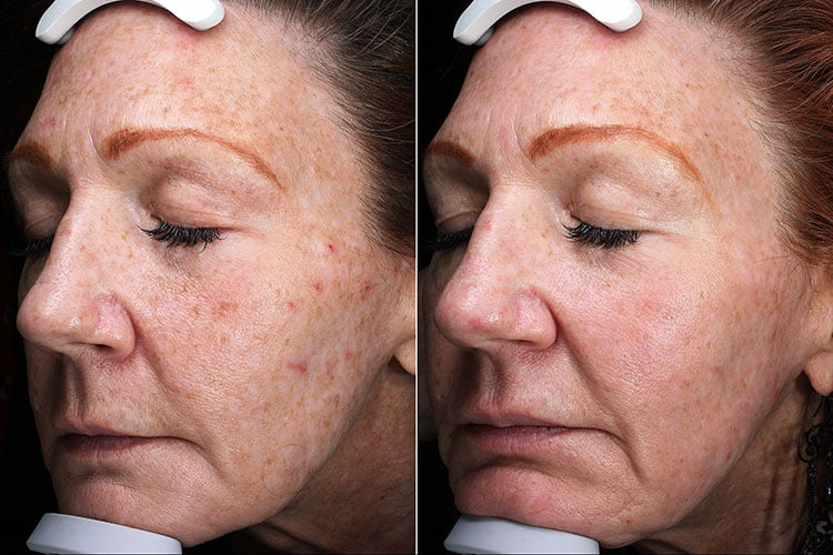 Before and after MixTo laser skin resurfacing treatments