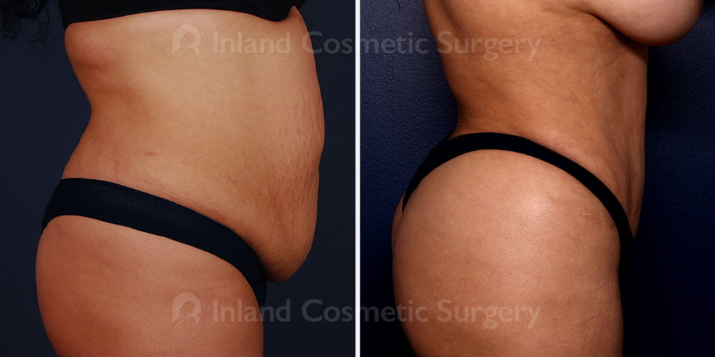 Liposuction