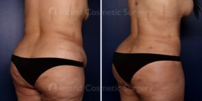 liposuction-brazilain-butt-lift-21506b-inlandcs