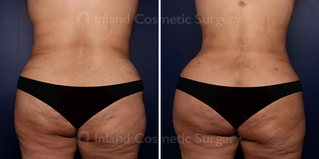 Liposuction and Brazilian Buttock Lift