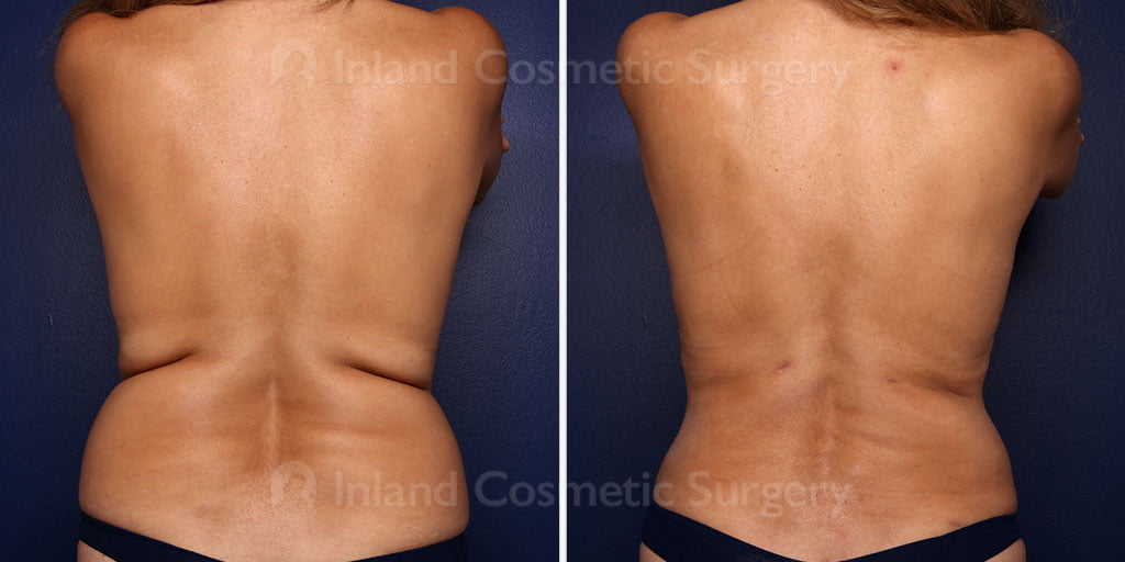 Liposuction and Renuvion