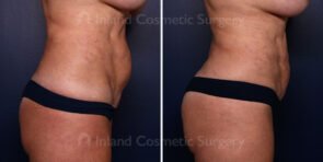 Liposuction and Renuvion