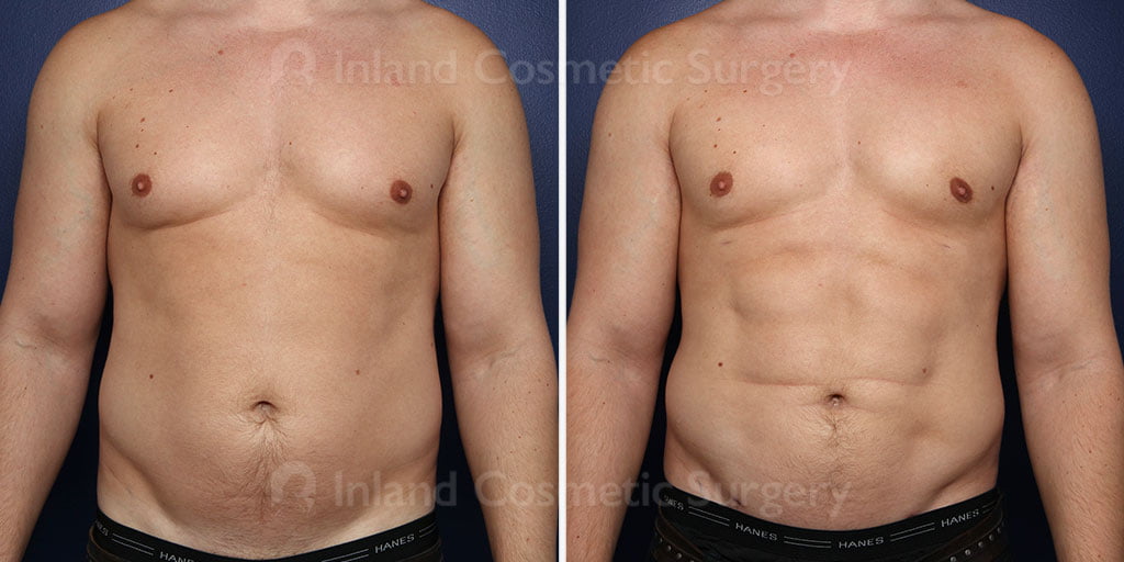 Before and after gynecomastia and liposuction