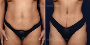Tummy Tuck with Tickle Liposuction