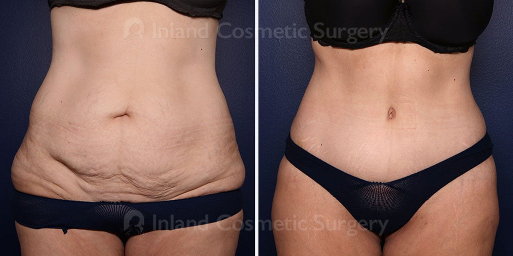 Before and after image of Tummy Tuck patient with liposuction for additional fat removal