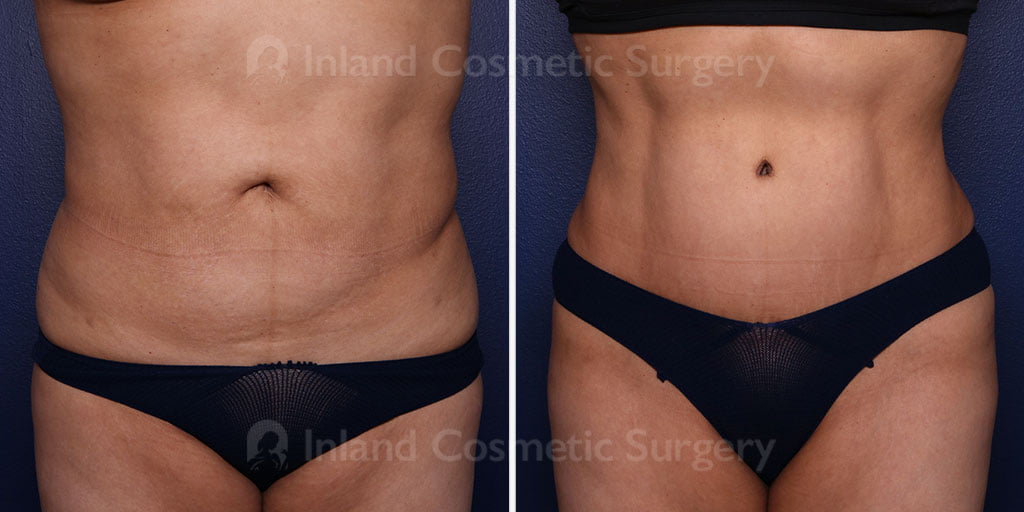 Tummy Tuck with Liposuction