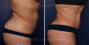 abdominoplasty-liposuction-21868c-inlandcs