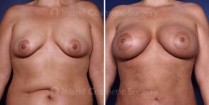 breast-augmentation-21853a-inlandcs