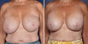 Breast Augmentation Revision Patient