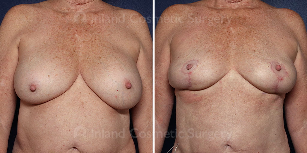 breast-implant-removal-lift-21940a-inlandcs