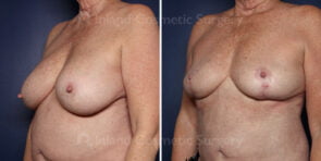 breast-implant-removal-lift-21940b-inlandcs