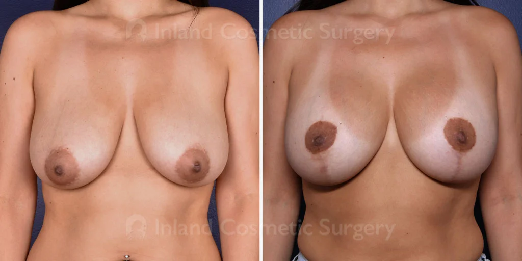 Breast Lift with Augmentation Patient
