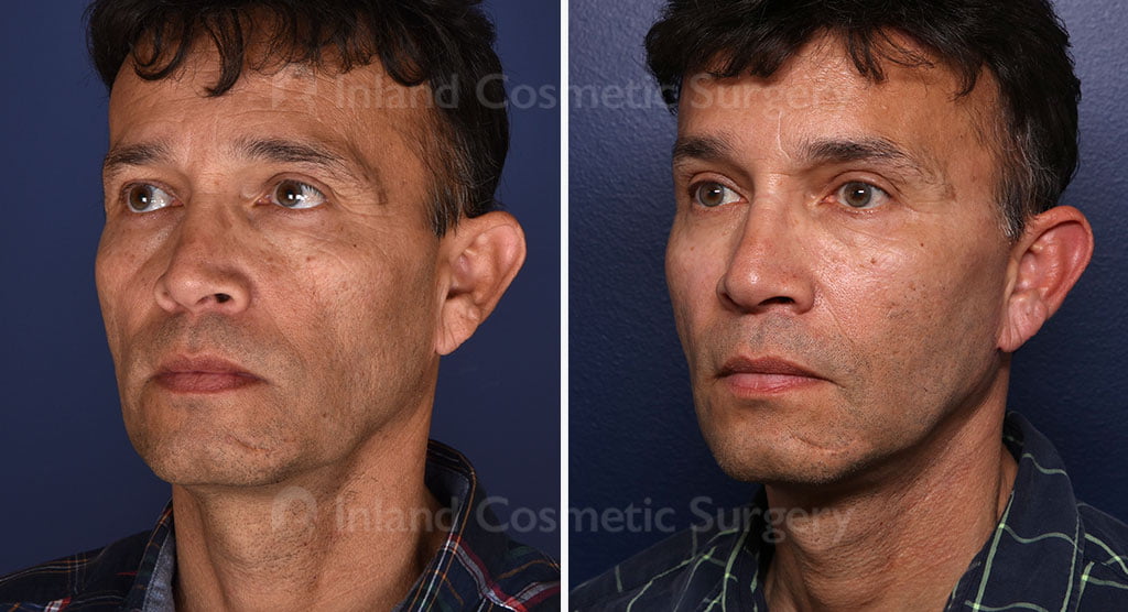 Male facial patient before and after
