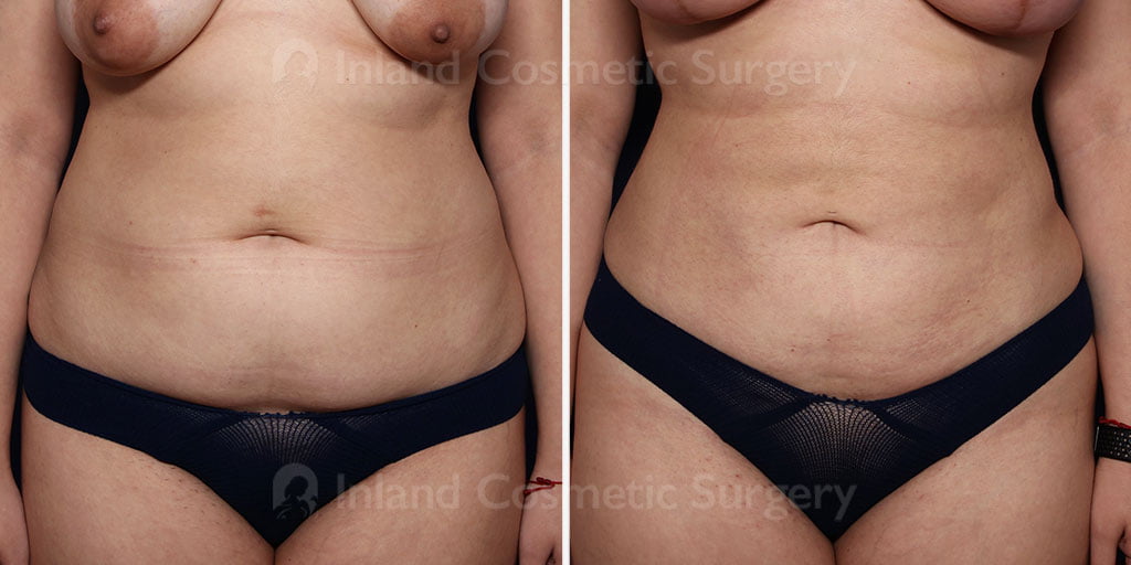 Liposuction with Renuvion
