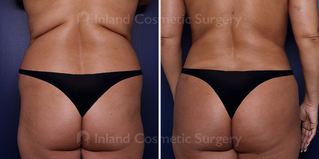 Liposuction and Fat Transfer to the Buttocks