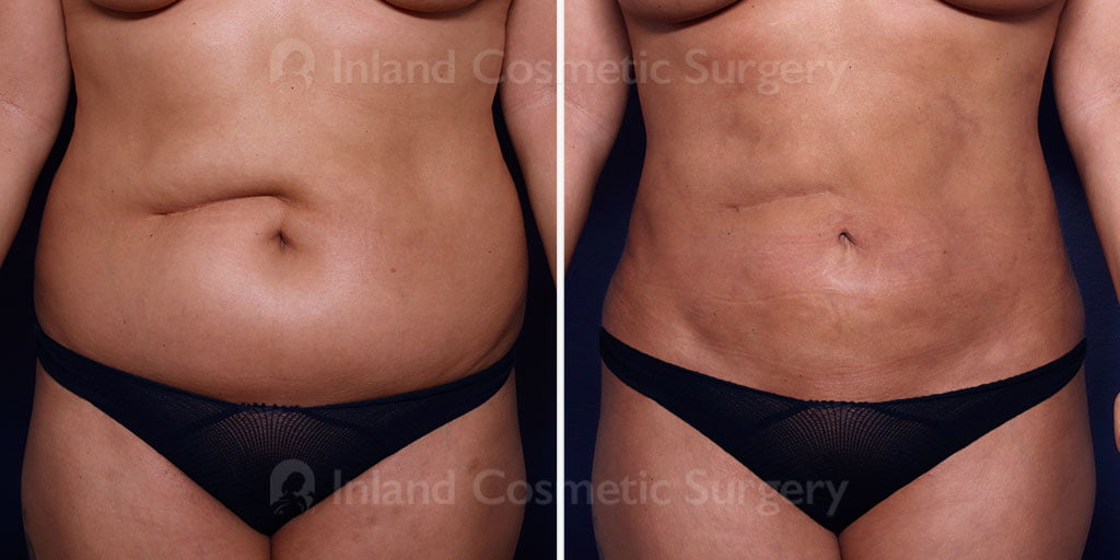 liposuction-fat-transfer-21853a-inlandcs
