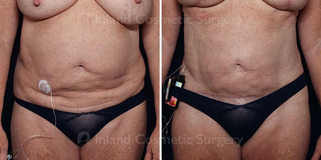 Liposuction with Renuvion