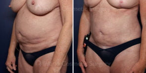 liposuction-renuvion-abdomen-21940b-inlandcs