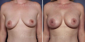 TUBA Breast Augmentation Patient