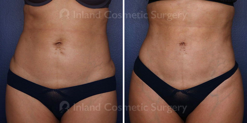 Liposuction with Renuvion