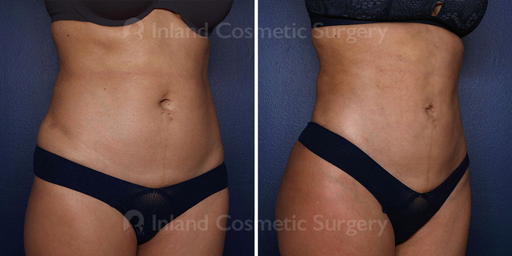 liposuction-renuvion-22063b-inlandcs