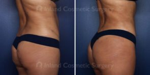 liposuction-waist-fat-transfer-22068cb–inlandcs
