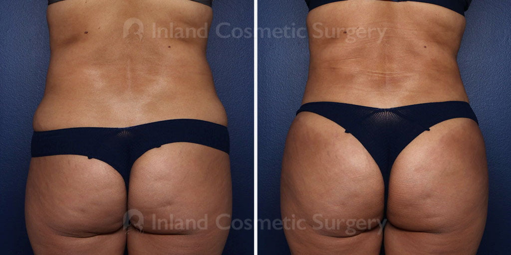 Liposuction with Fat Transfer