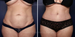 Tummy Tuck with Liposuction