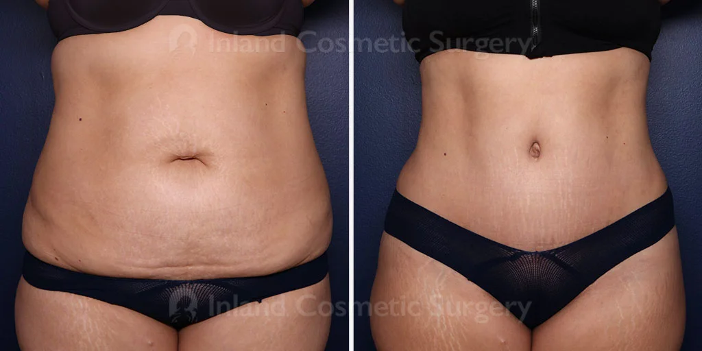 Tummy Tuck with Liposuction